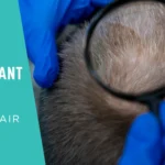 Revision Hair Transplant_UniquEra_Clinic