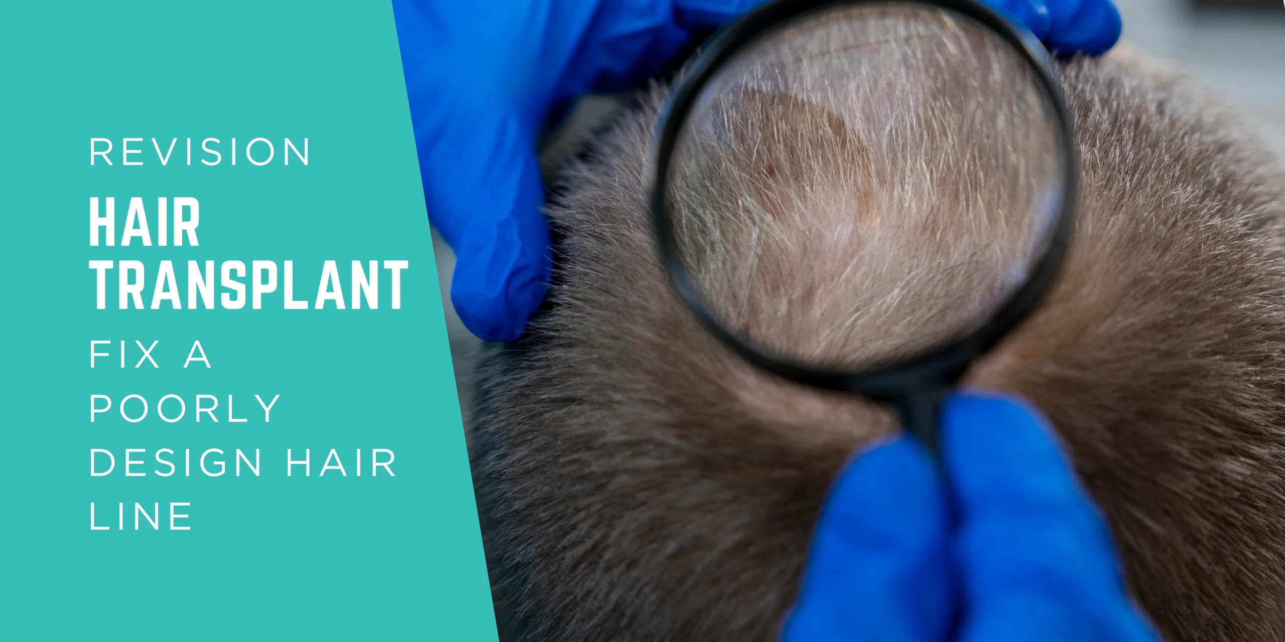 Can Revision Hair Transplantation Fix a Poorly Designed Hairline from a Previous Transplant?