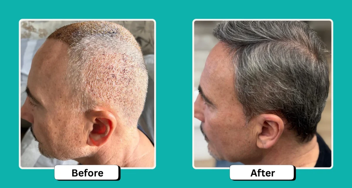 Does Donor Area Hair Grow Back After Hair Transplant Surgery?