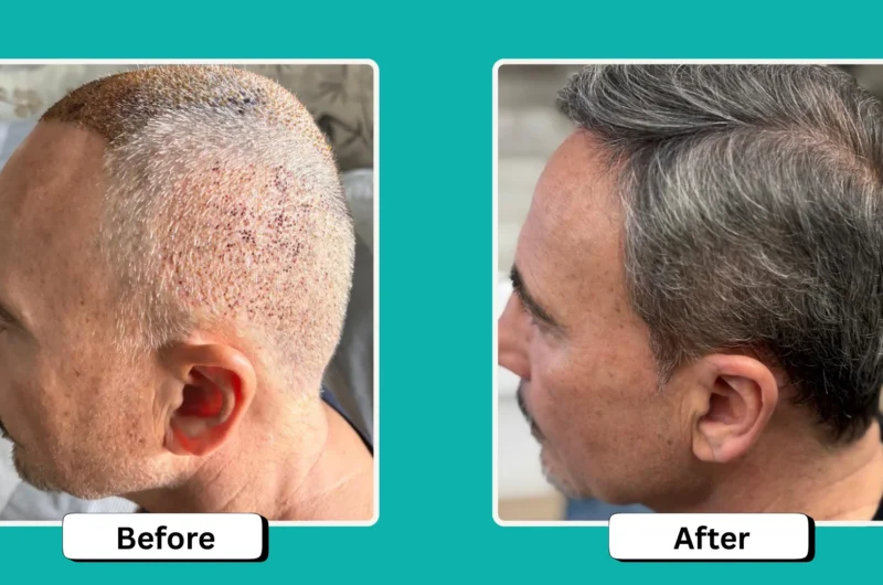 Does Donor Area Hair Grow Back After Hair Transplant Surgery?