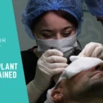 Hair Transplant Cost Explained