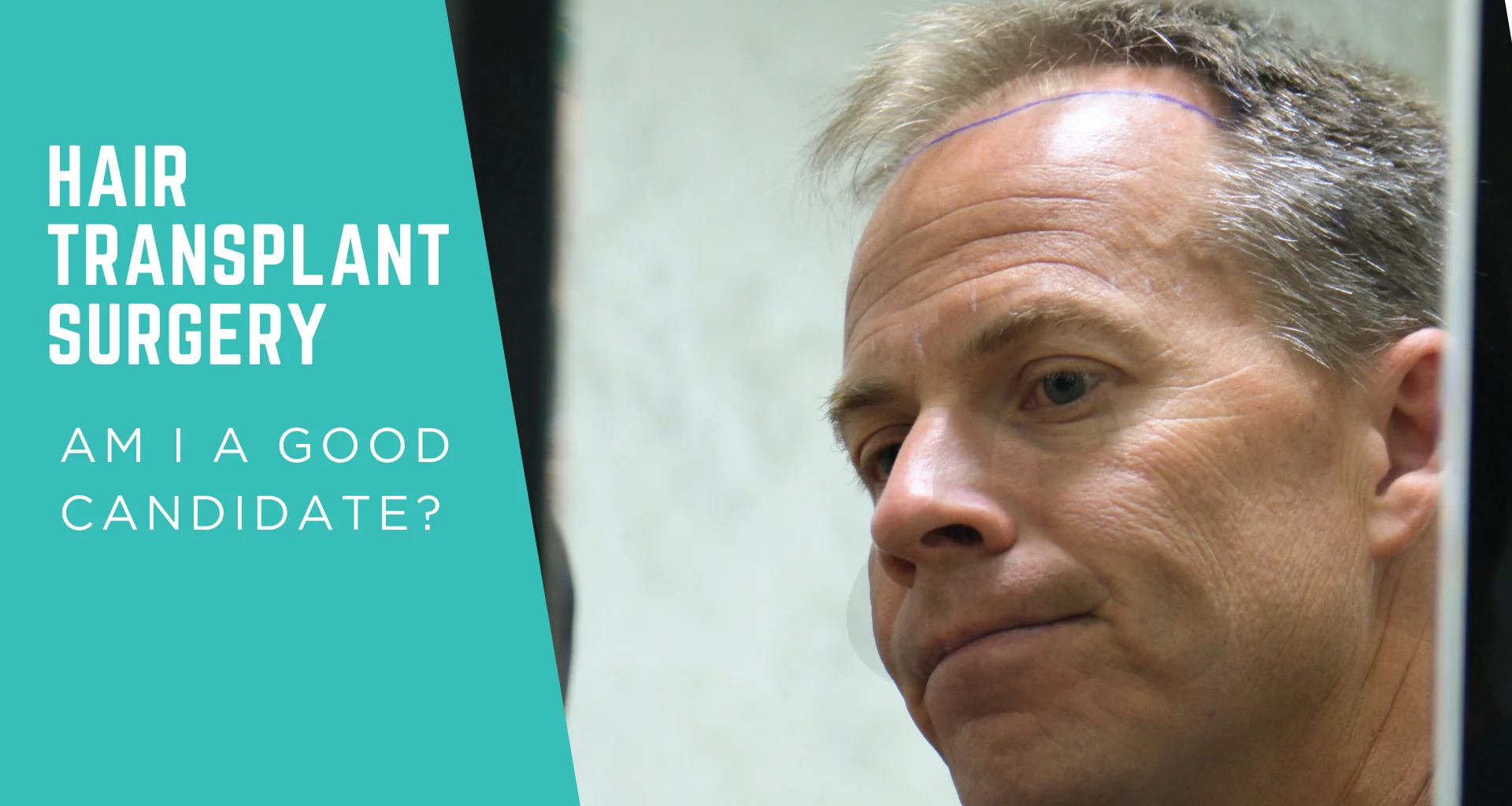 Hair Transplant Surgery: Am I a Good Candidate?
