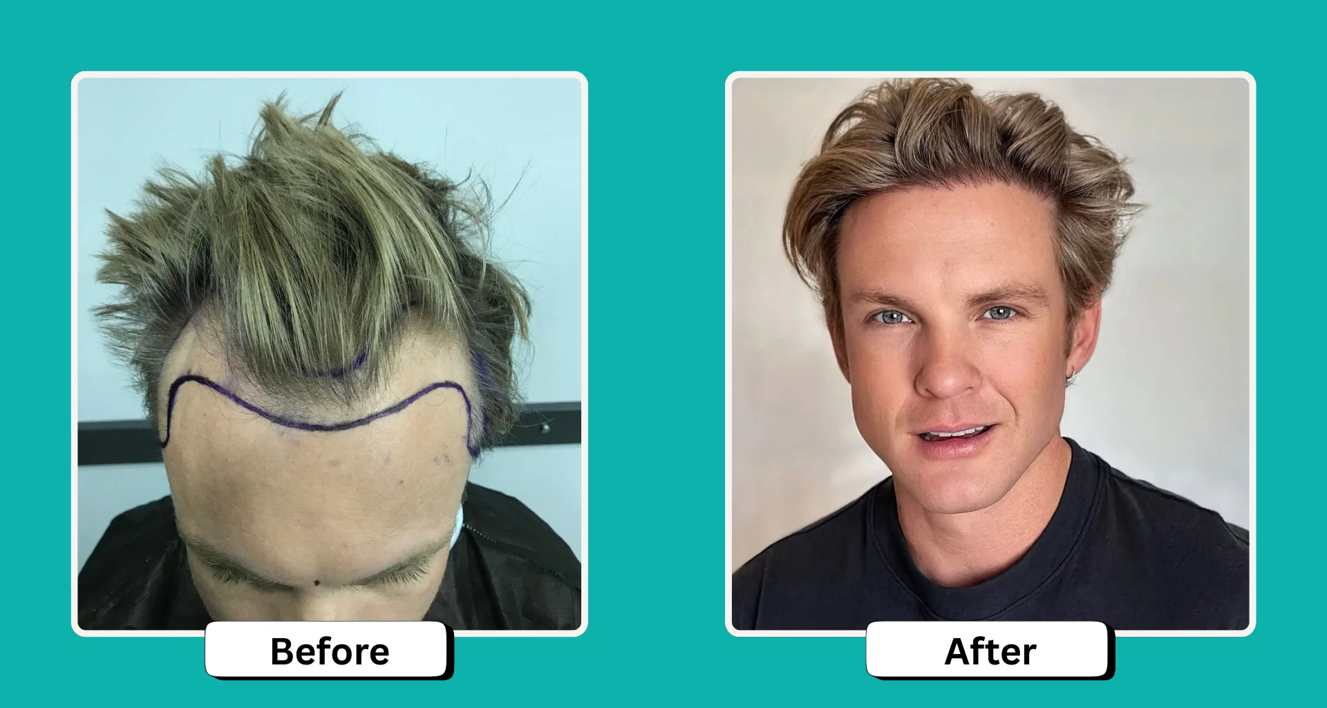 Hair Transplant Without Finasteride: Does It Work?