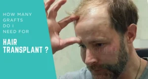 Home 69 how many hair grafts do i need