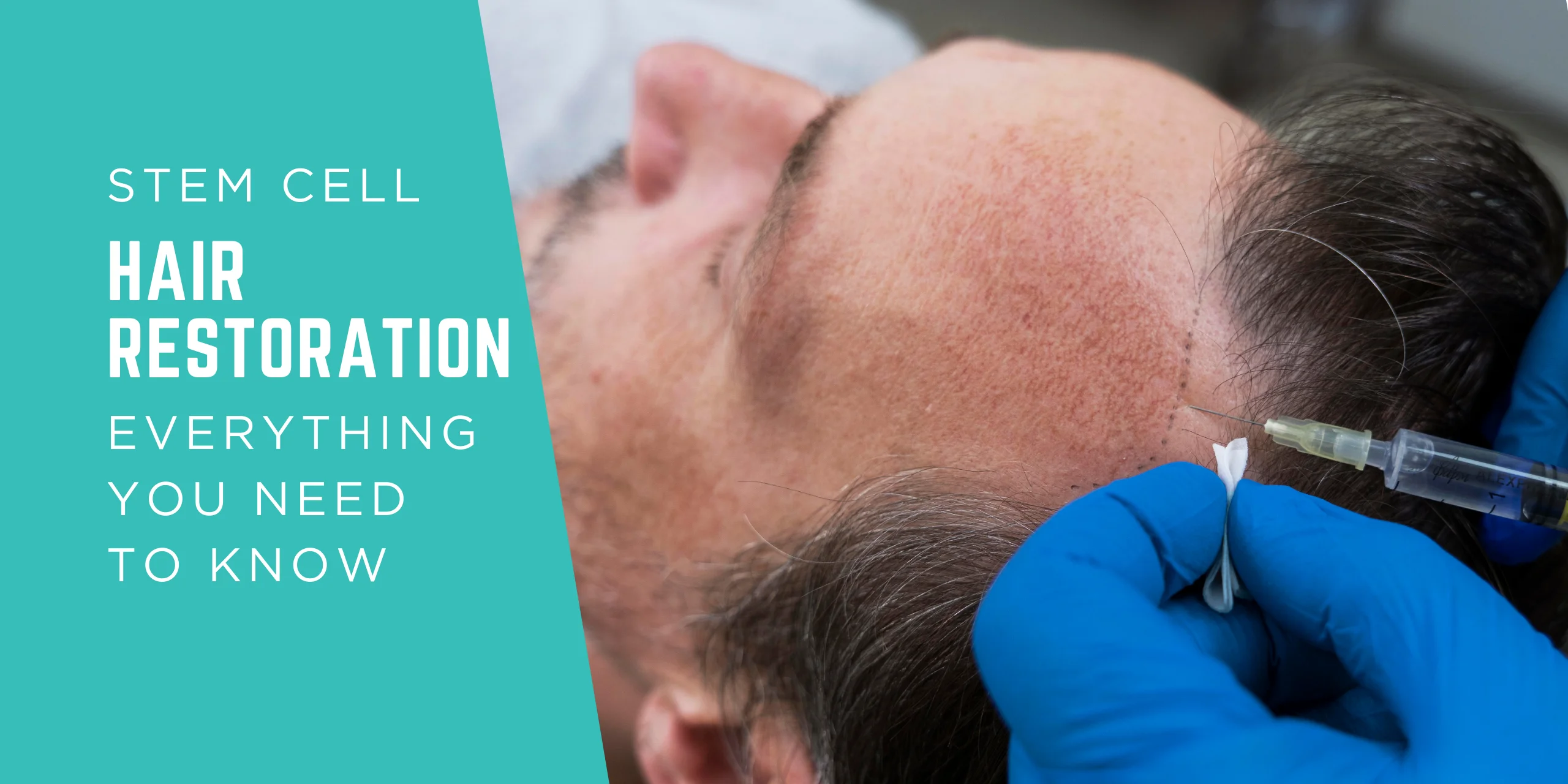 Stem Cell Hair Restoration: Everything You Should Know Before Surgery