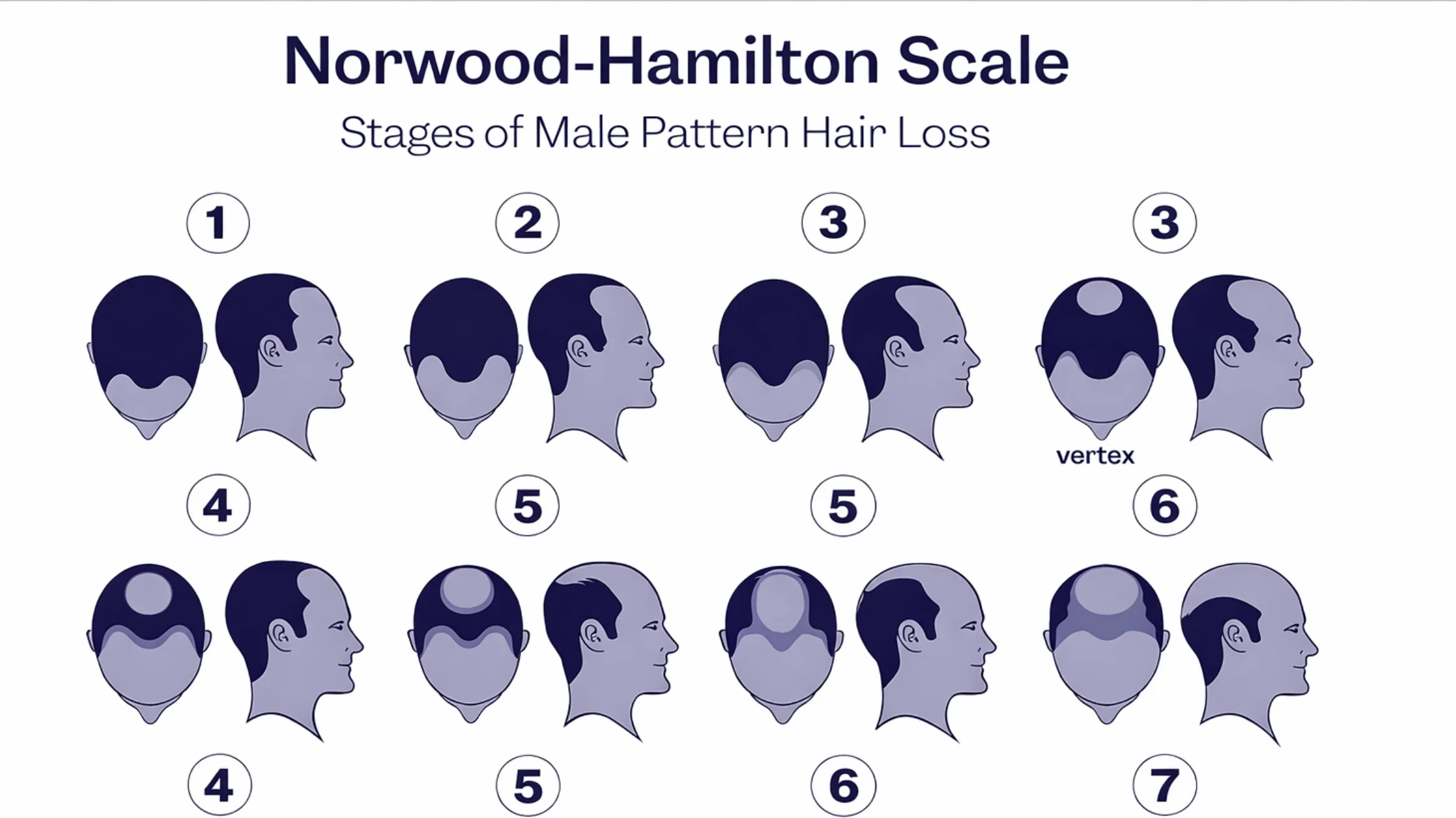 What Is the Norwood Hamilton Scale and Why It Is Important for Hair Transplant Patients?