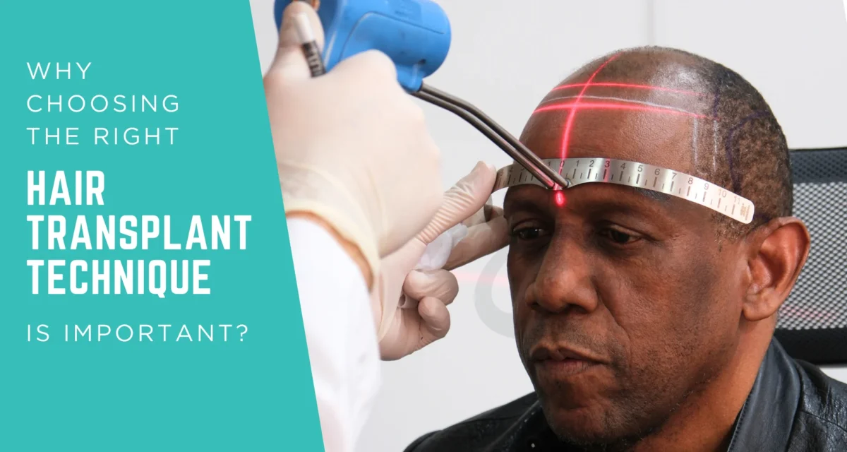 Why Choosing the Right Hair Transplant Technique Is Important for Natural Results
