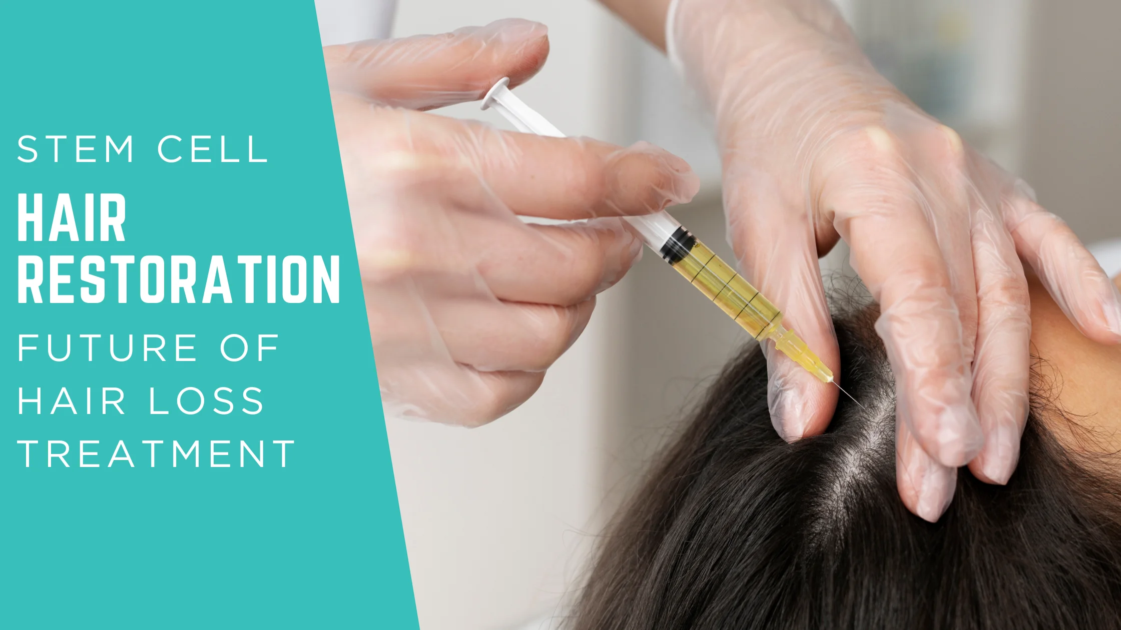 Why Stem Cell Hair Restoration Is the Future of Hair Loss Treatment