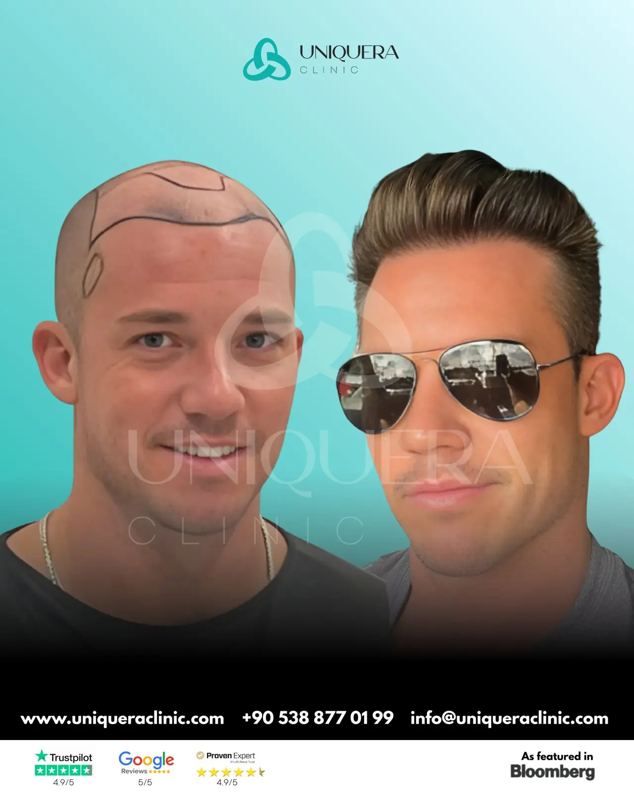 Hair transplant transformation
