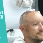 Hair Transplant Aftercare
