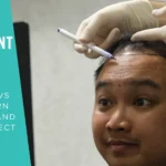 Hair Transplant Surgery