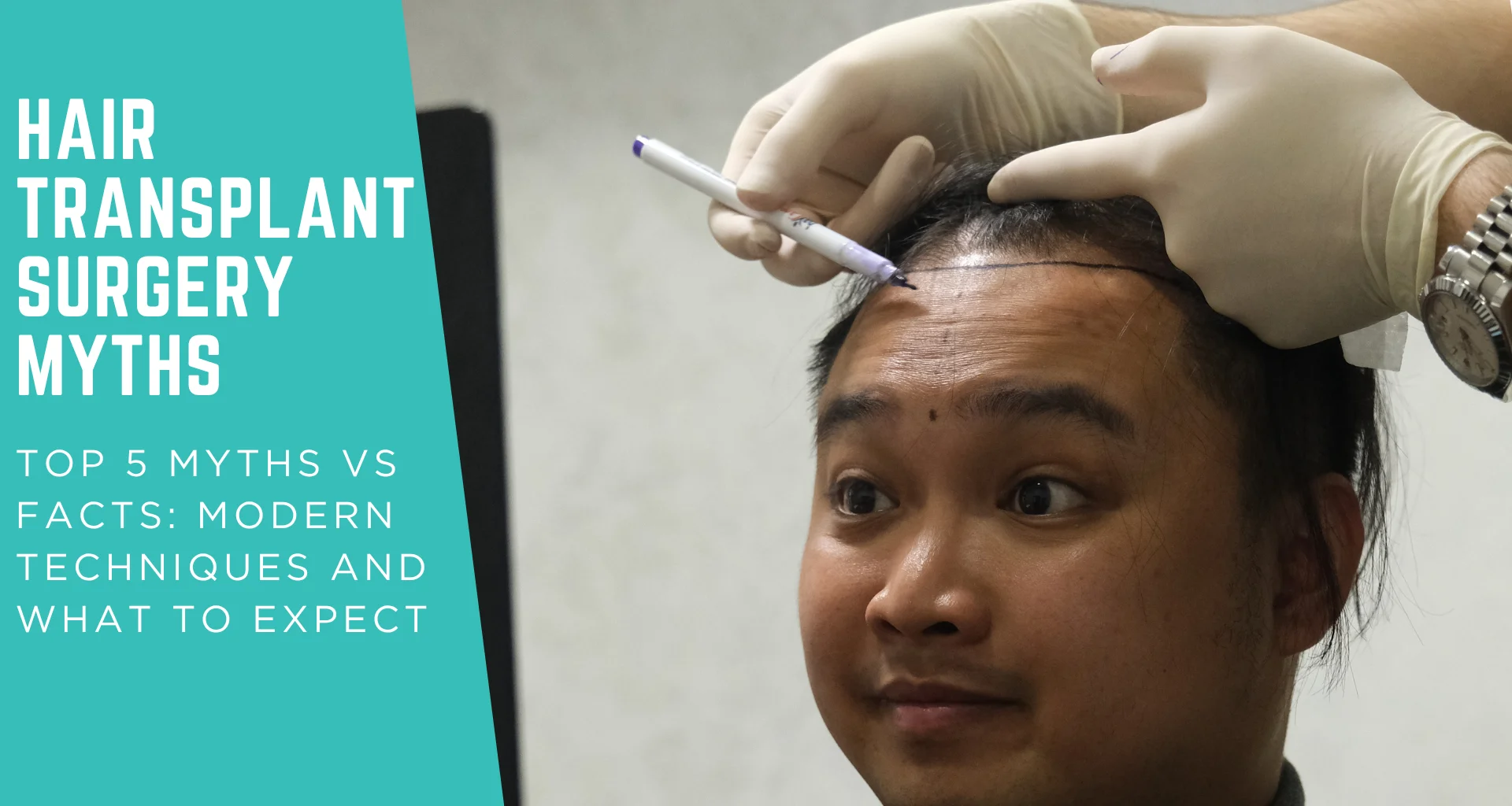 Top 5 Hair Transplant Surgery Myths vs Facts: Modern Techniques and What to Expect