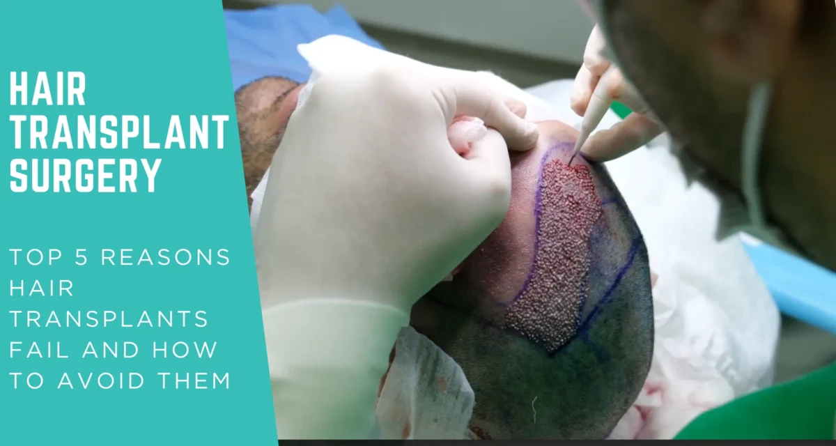 Top 5 Reasons Hair Transplants Fail and How to Avoid Them?