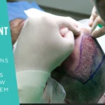 Top 5 Reasons Hair Transplants