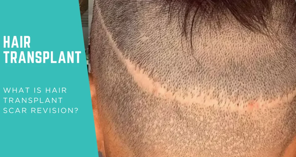 What Is Hair Transplant Scar Revision?