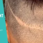 Hair Transplant Scar