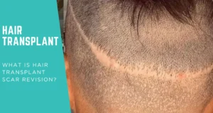 Hair Transplant Scar