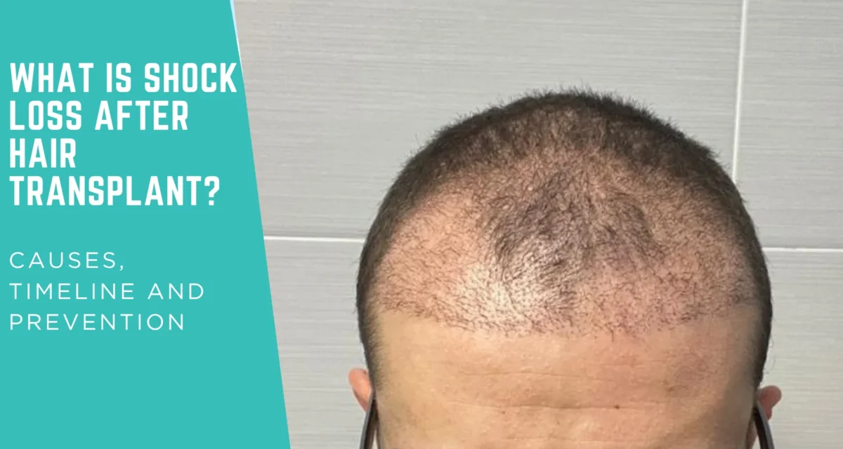 What Is Shock Loss After Hair Transplant? Causes, Timeline and Prevention