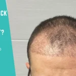 What Is Shock Loss After Hair Transplant Causes, Timeline and Prevention