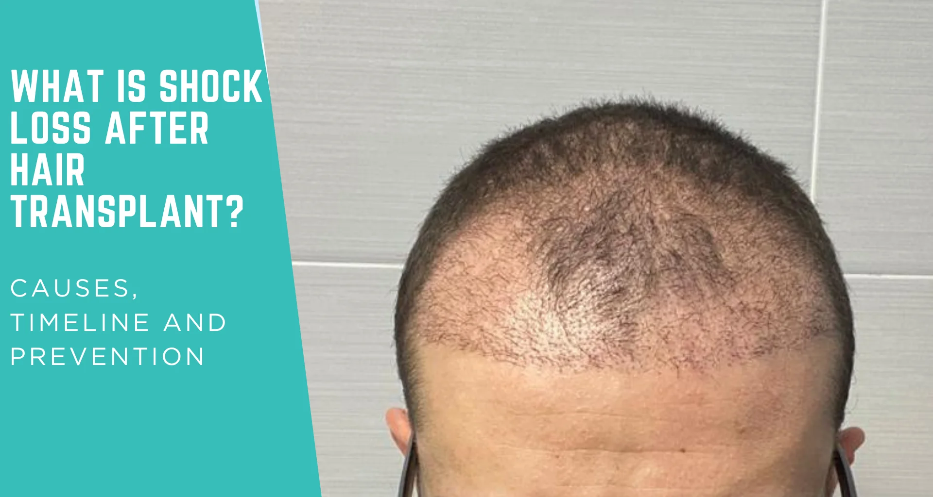 What Is Shock Loss After Hair Transplant? Causes, Timeline and Prevention