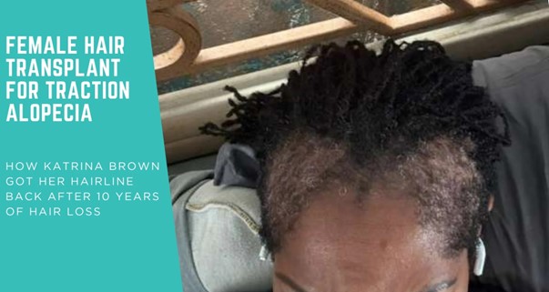 Female Hair Transplant for Traction Alopecia: How Katrina Brown Restored Her Hairline with DHI