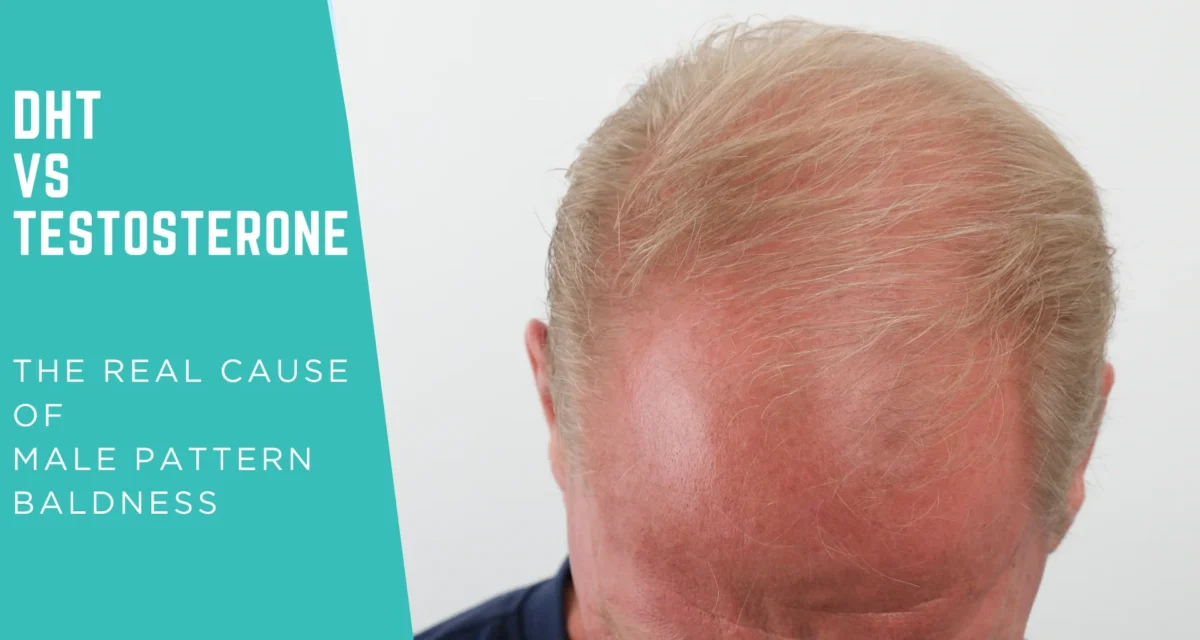 DHT vs Testosterone: The Real Cause of Male Pattern Baldness