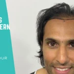 Diffuse Thinning vs Male Pattern Baldness