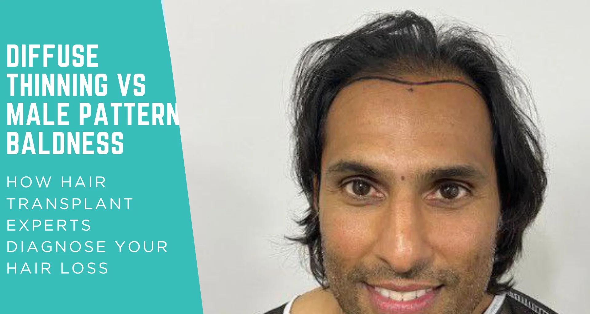 Diffuse Thinning vs Male Pattern Baldness: How Hair Transplant Experts Diagnose Your Hair Loss