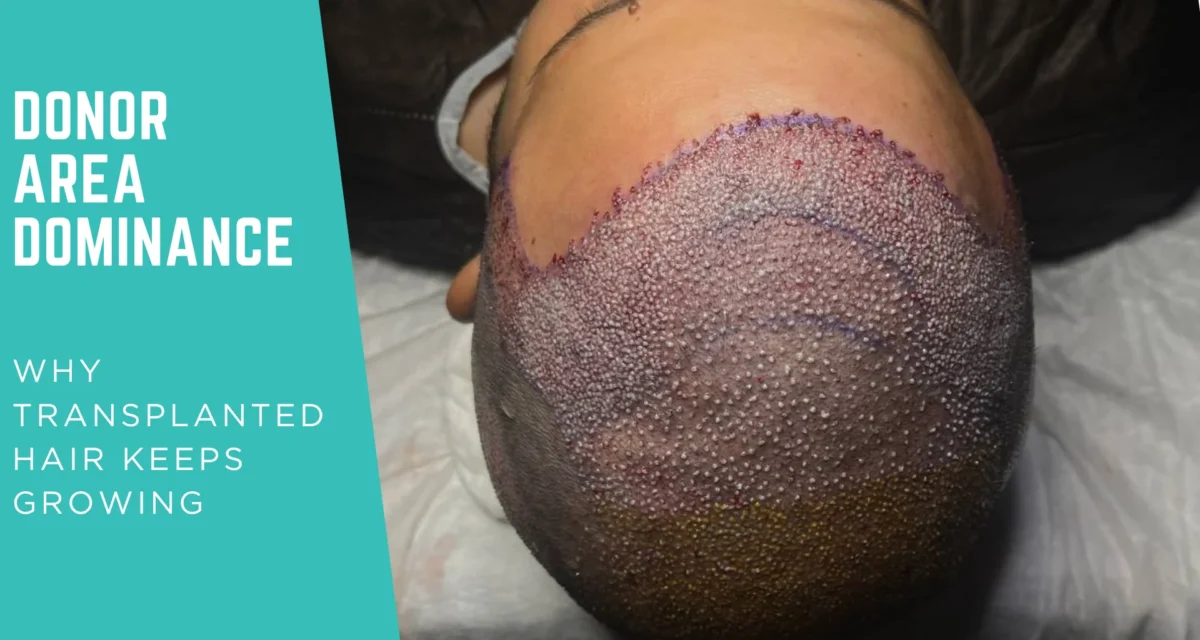 Donor Area Hair Transplant: Why Transplanted Hair Keeps Growing