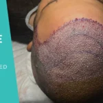 Donor Area Hair Transplant: Why Transplanted Hair Keeps Growing