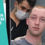 Hair Transplant Consultation: What Happens and What to Ask