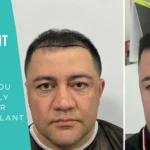 Hair Transplant Results