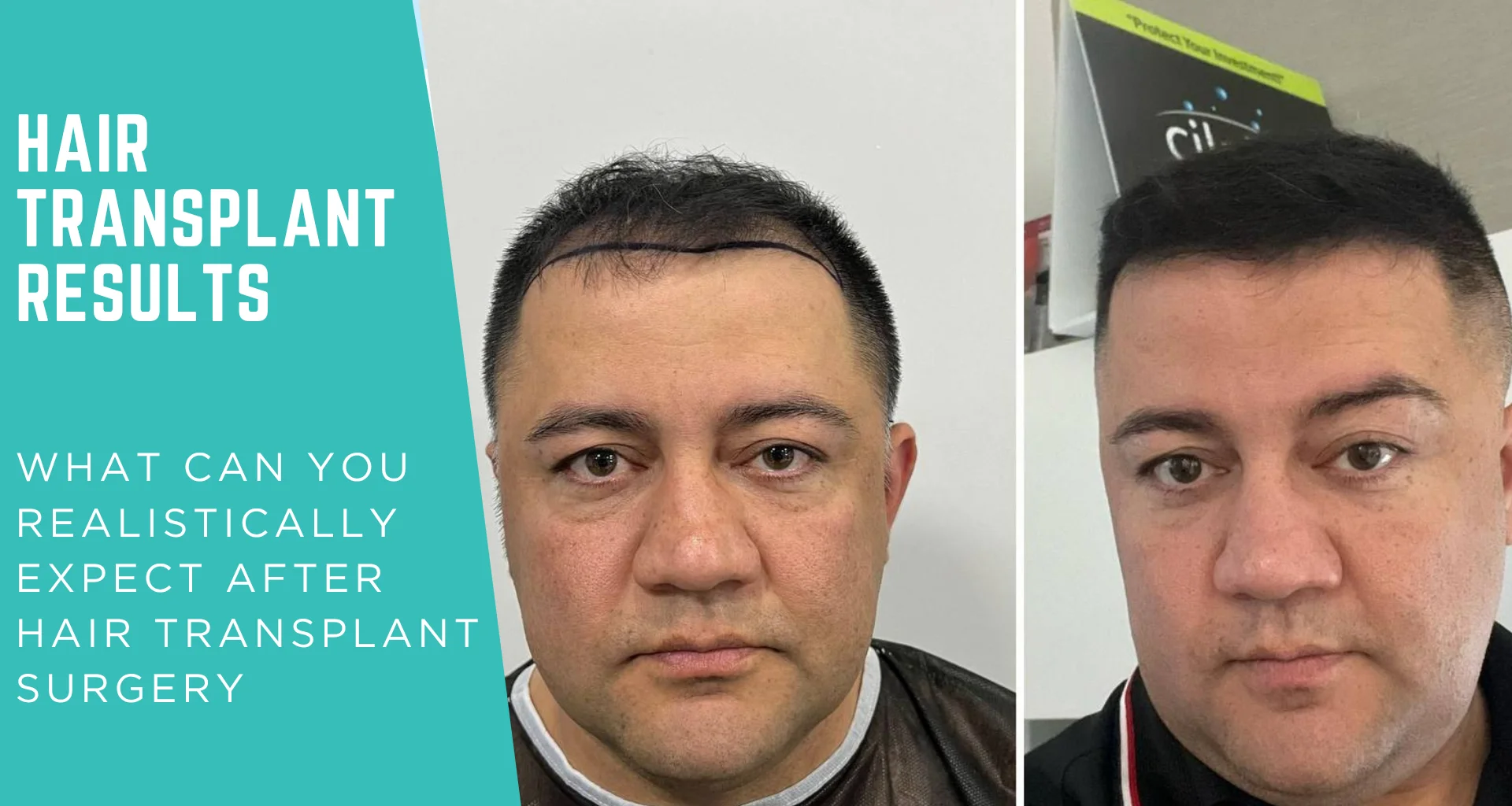 Hair transplant results: what to realistically expect after hair transplant surgery