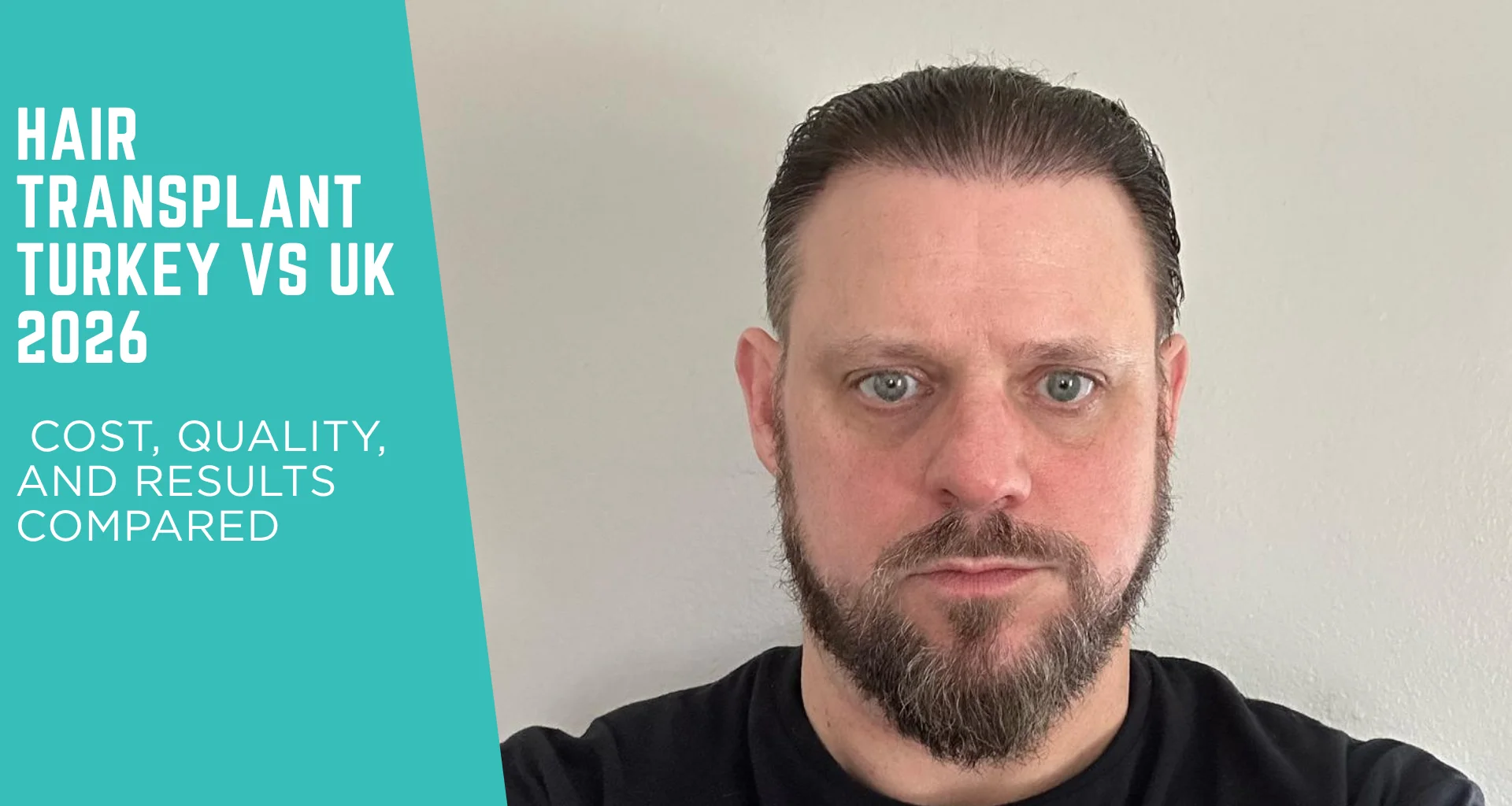 Hair Transplant Turkey vs UK 2026: Cost, Quality, and Results Compared