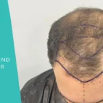 Hairline Design Hair Transplant: What Actually Makes Results Look Natural
