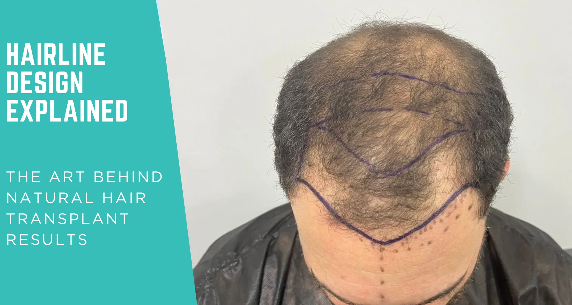 Hairline Design Hair Transplant: The Art Behind Natural Hair Transplant Results