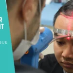 Hairline Design Hair Transplant Why Technique Alone Isn’t Enough