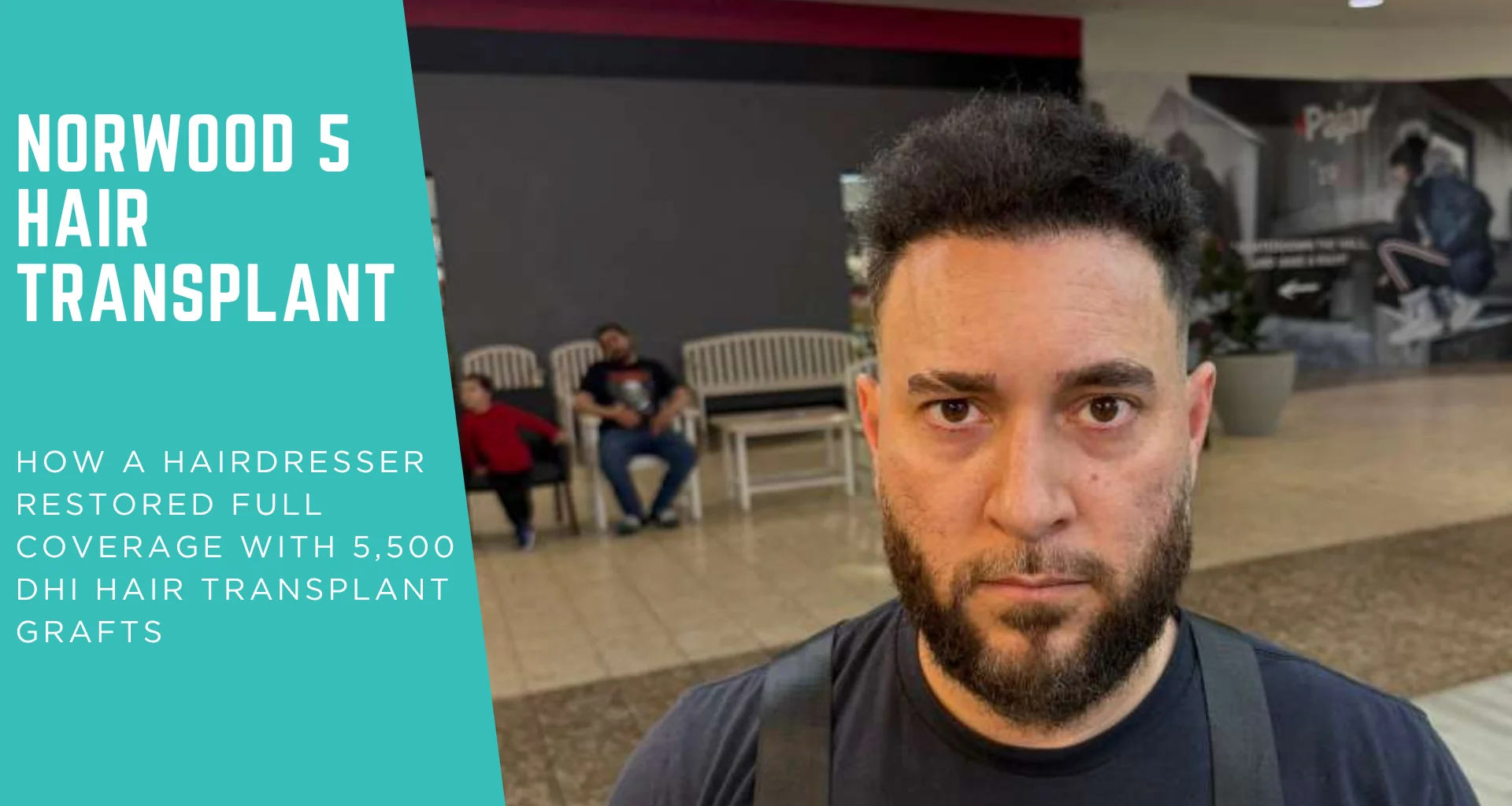 Norwood 5 hair transplant: how a hairdresser restored full coverage with 5,500 DHI hair transplant grafts