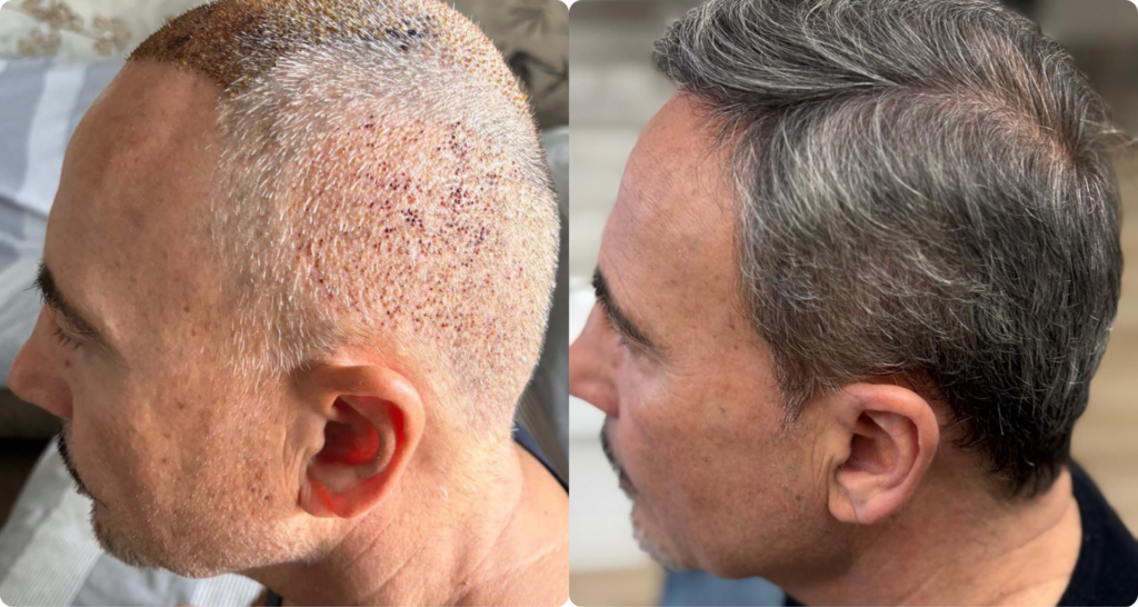What Is the Donor Area in a Hair Transplant?