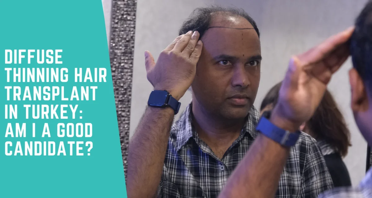 Diffuse Thinning Hair Transplant in Turkey: Am I a Good Candidate?