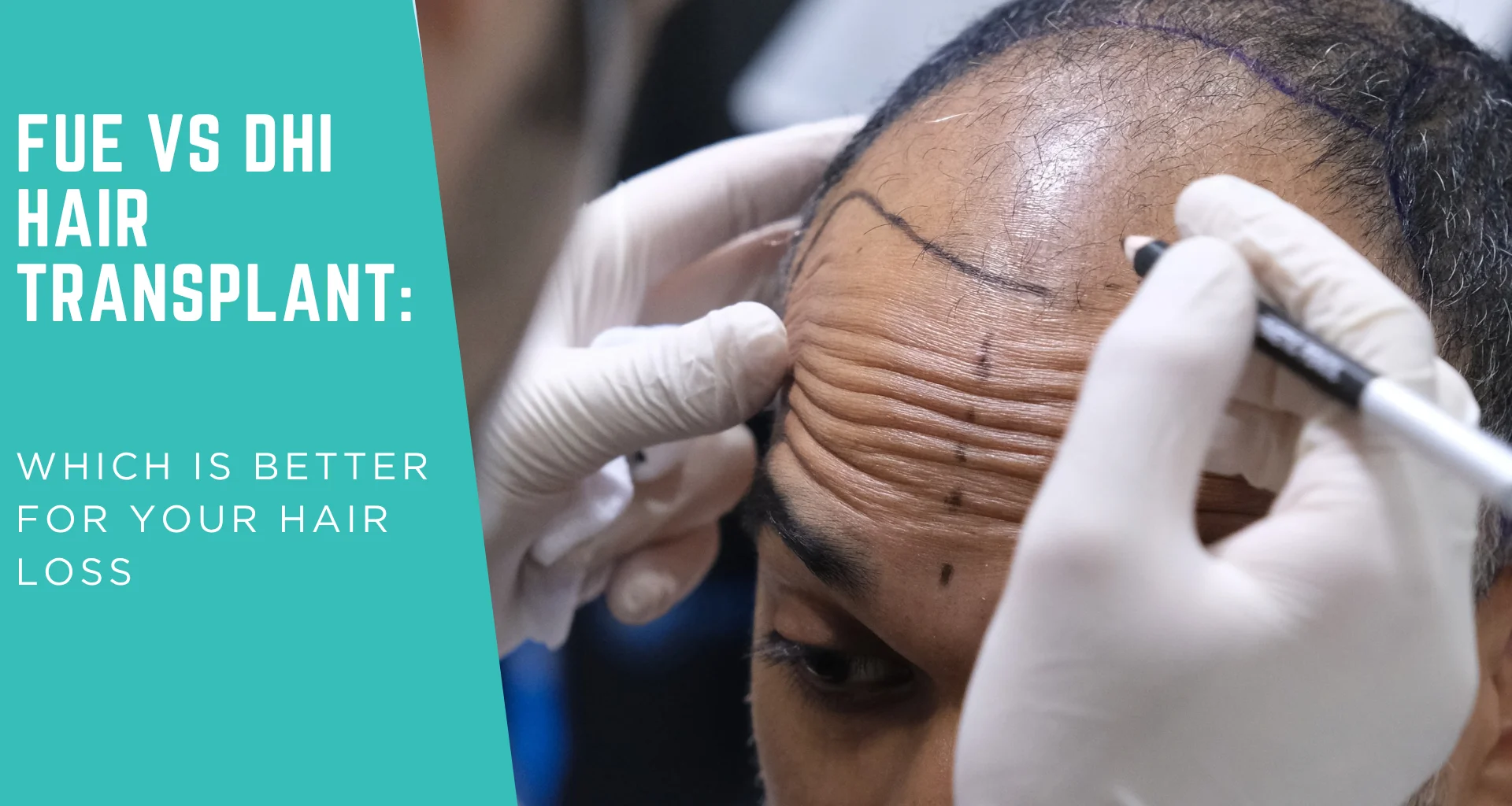 FUE vs DHI Hair Transplant: Which Is Better for Your Hair Loss?