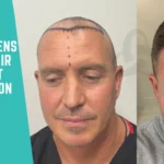 What Happens During a Hair Transplant Consultation_UniquEra_Clinic