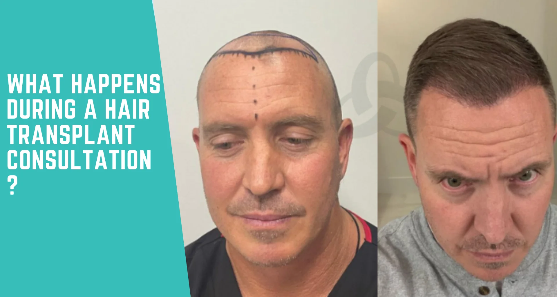 What Happens During a Hair Transplant Consultation? What to Expect & How It Works