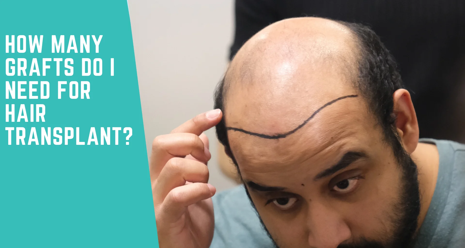 How Many Grafts Do I Need for a Hair Transplant?