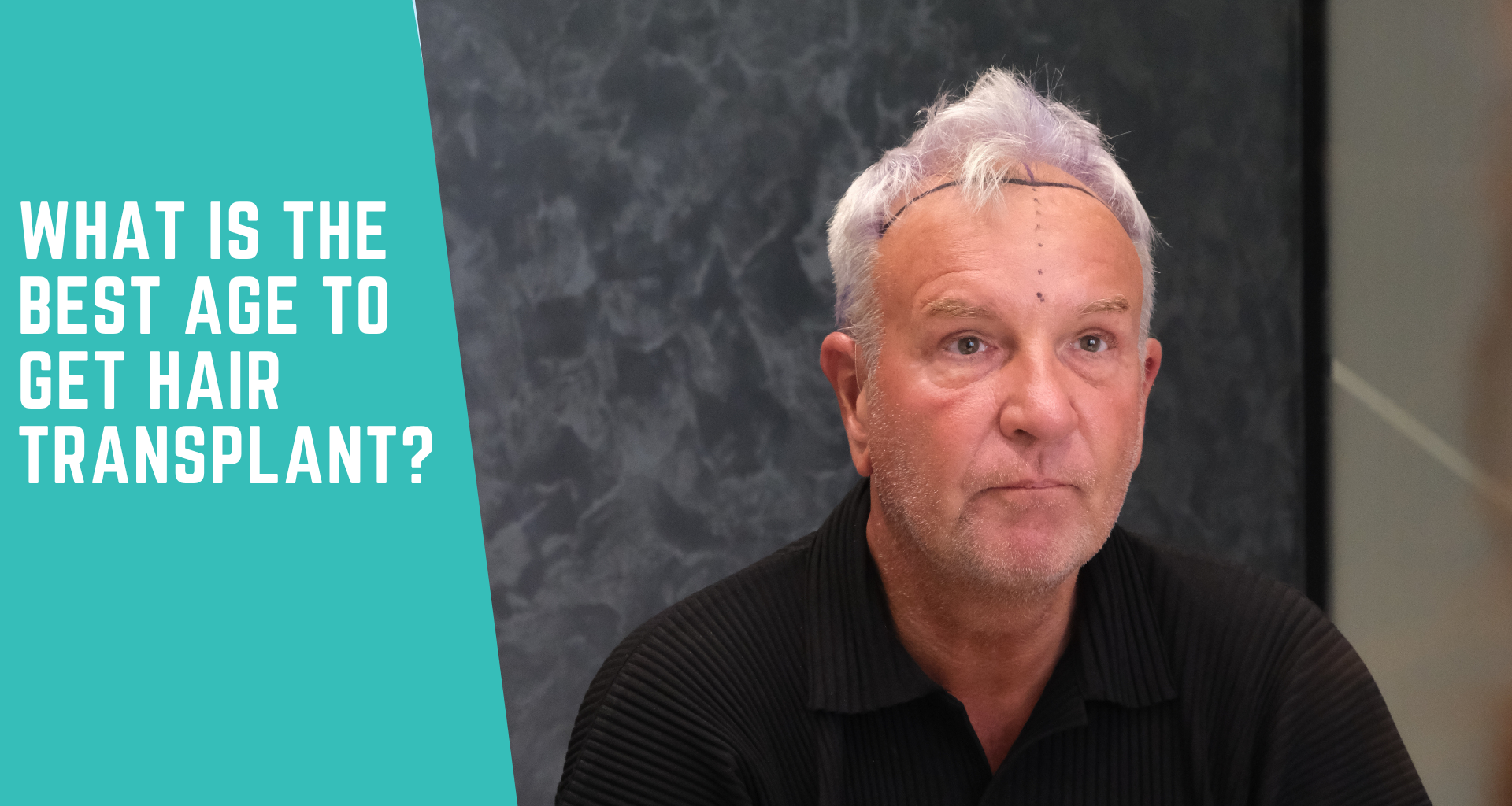 Best age to get a hair transplant: what do doctors actually recommend?
