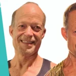 Dan Caverly's Hair Transplant Before and After