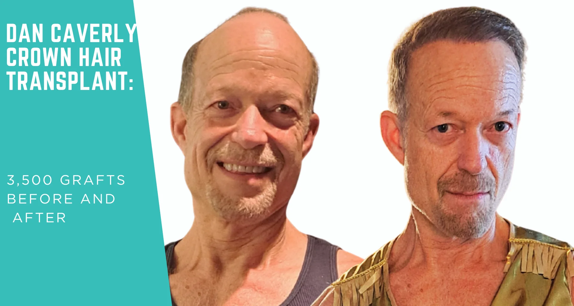 Dan Caverly’s Hair Transplant Before and After: 3,500 Grafts DHI for Crown Density at UniquEra