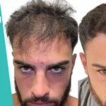 Diffuse Unpatterned Alopecia
