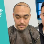 high-density hair transplant
