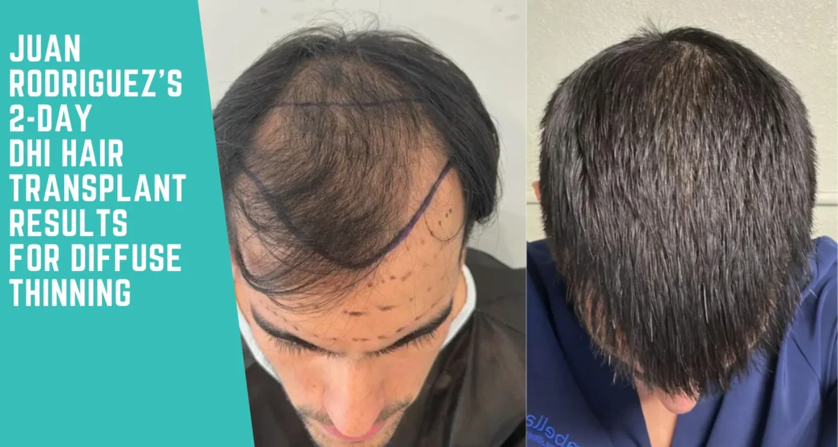Juan Rodriguez’s 2-Day DHI Hair Transplant Results for Diffuse Thinning